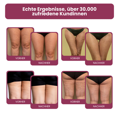 Ayleno 3D Kompressionsleggings mit abgestufter Kompression gegen Lipödeme